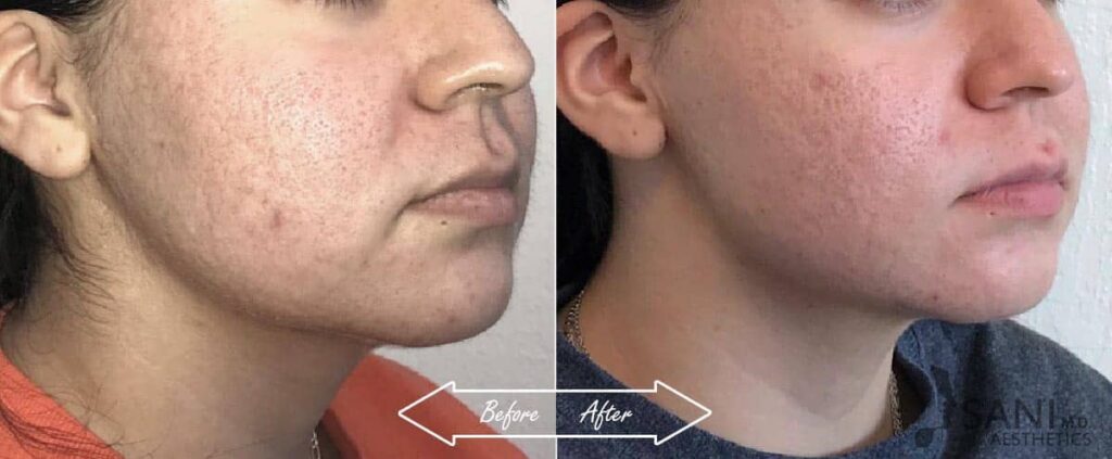 Acne Scar Removal Before After First