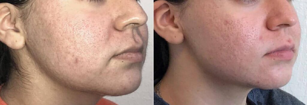 Acne Scar Removal Before After First