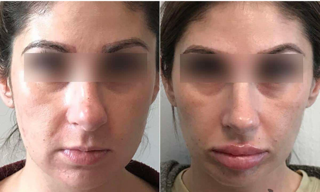 Aquagold Before After