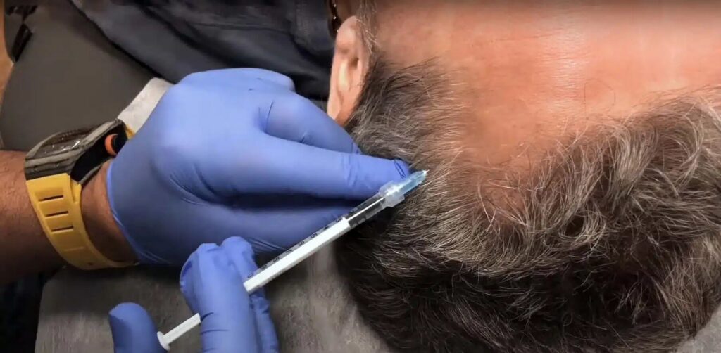 BOTOX Hair Restoration Treatments