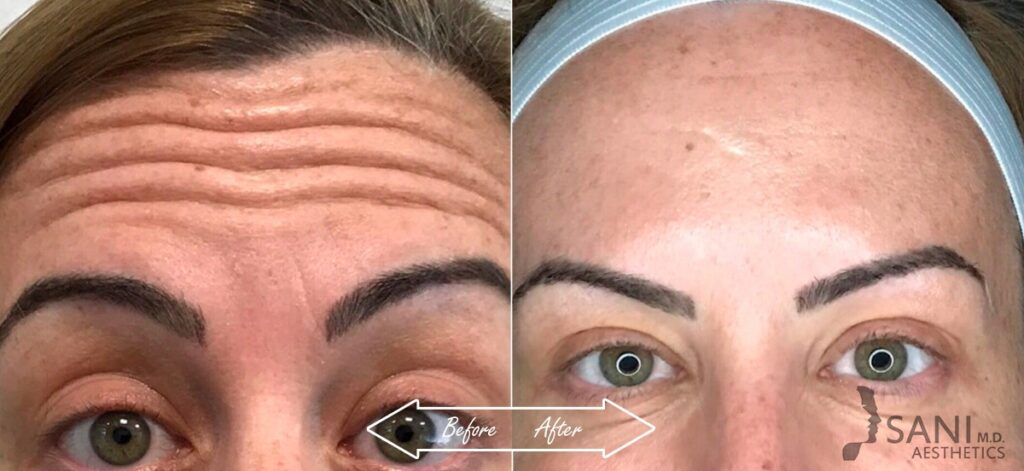Botox Cosmetic Before After