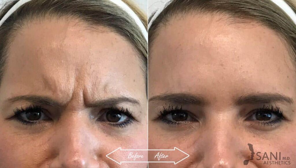 Botox Cosmetic Before After