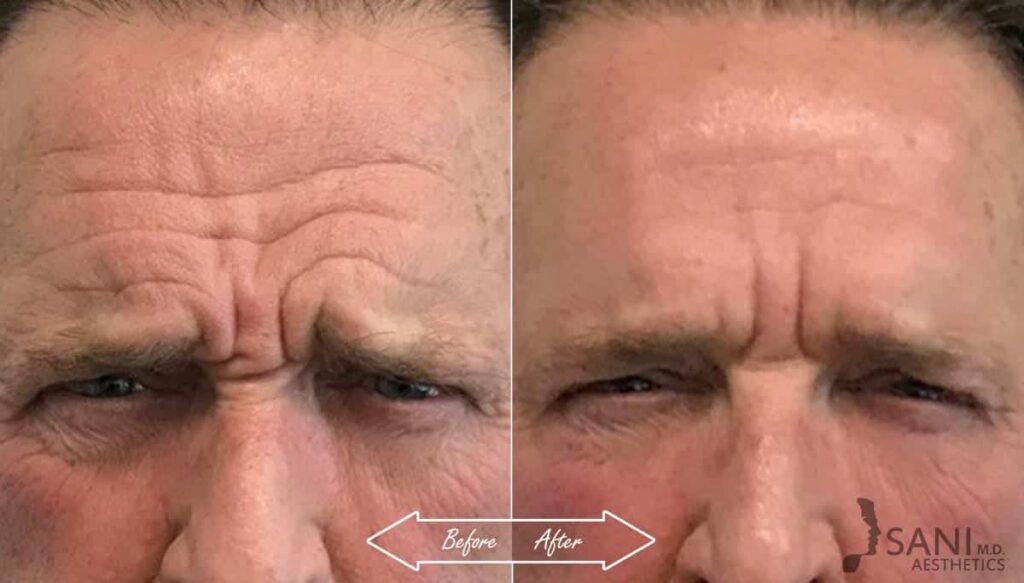 Botox Cosmetic Before After