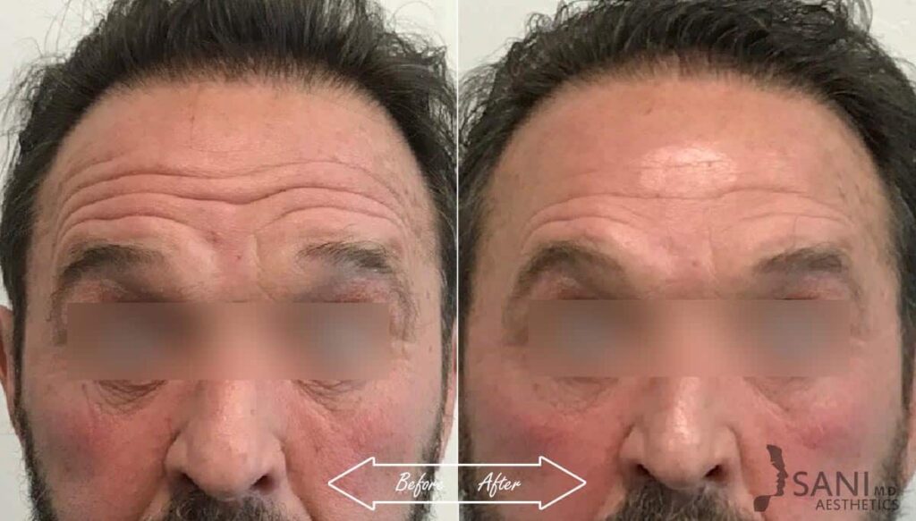 Botox Cosmetic Before After