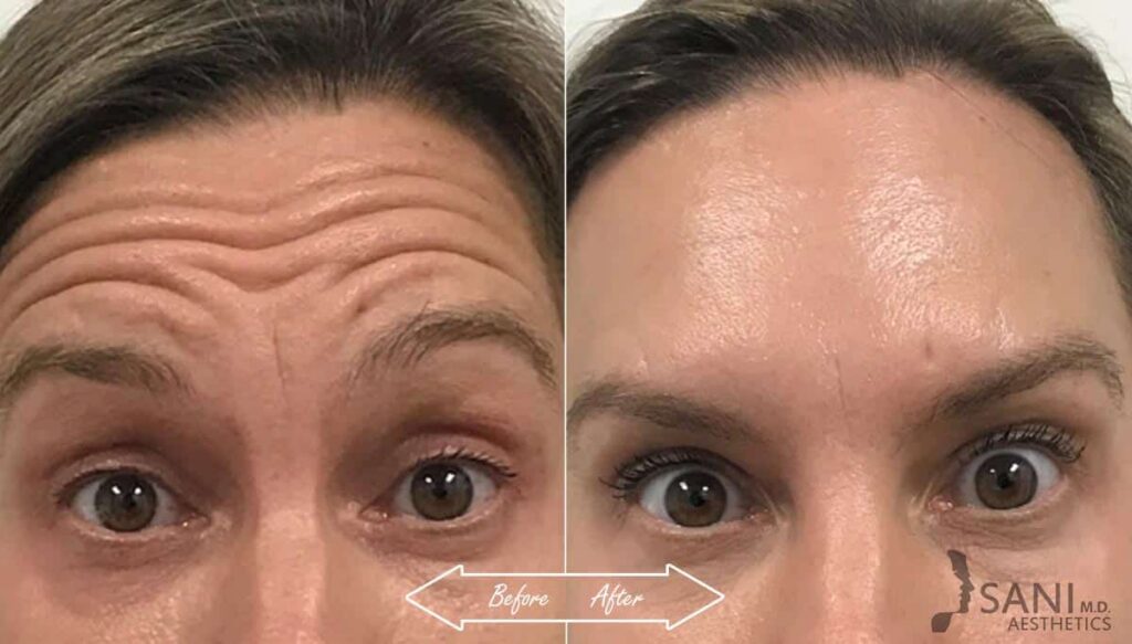 Botox Cosmetic Before After