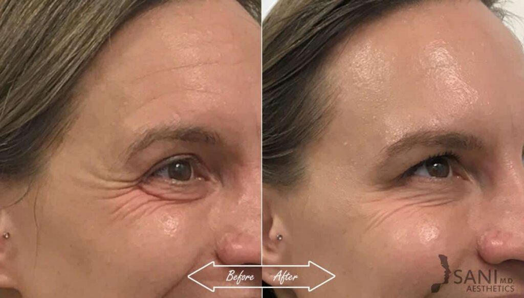 Botox Cosmetic Before After
