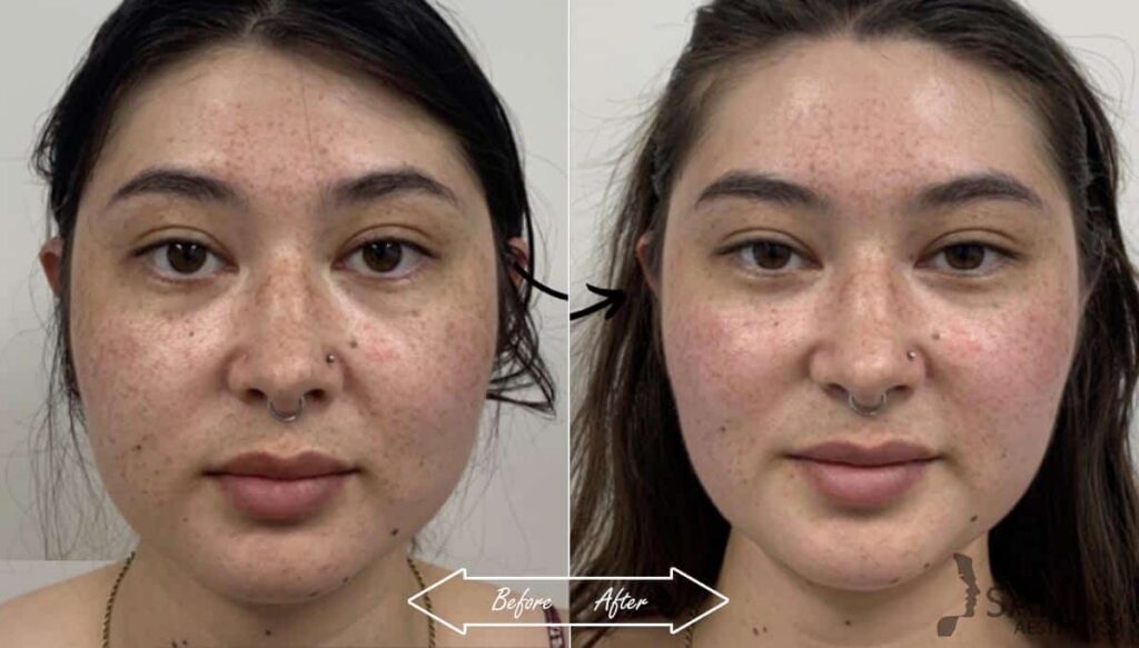 Botox Cosmetic Before After