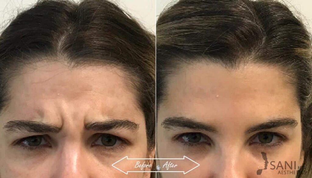 Botox Cosmetic Before After