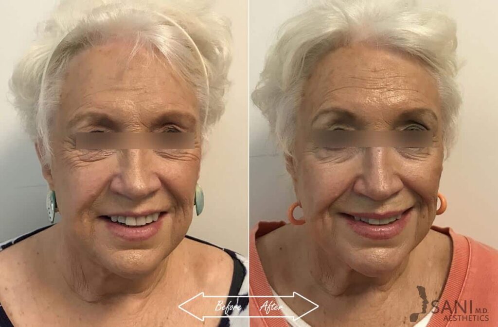 Botox Cosmetic Before After First