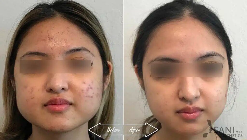 Botox Cosmetic Before After