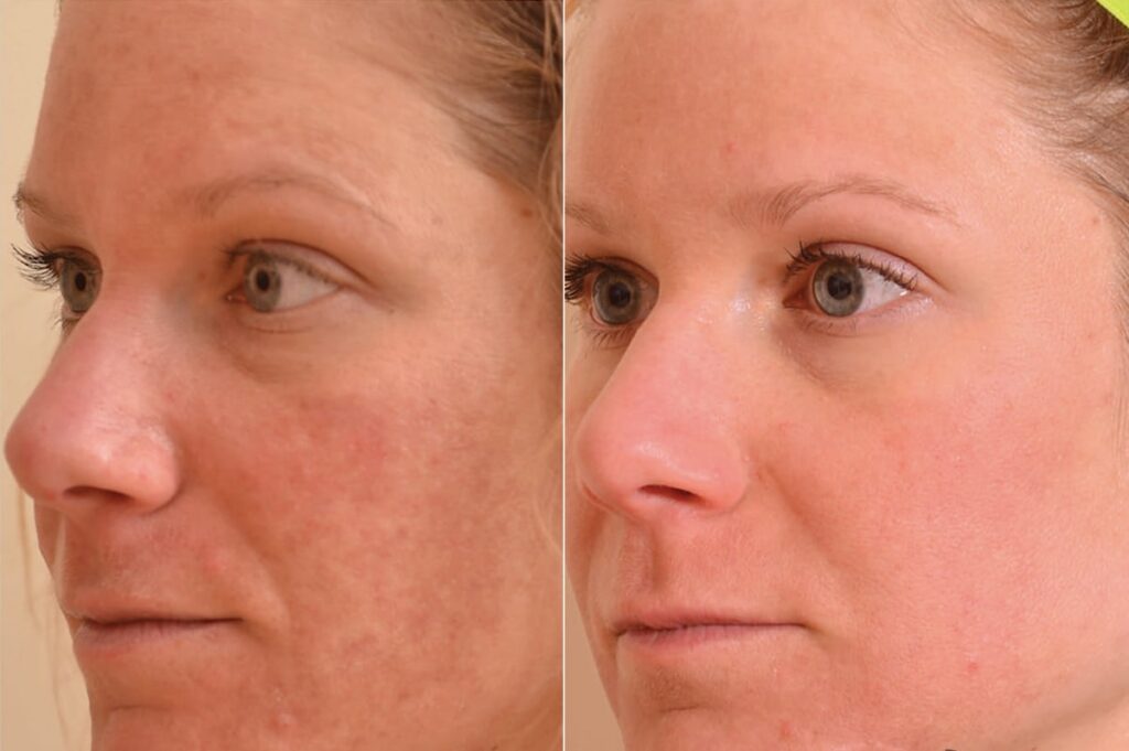 Chemical Peels Before After