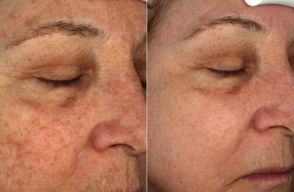Chemical Peels Before After