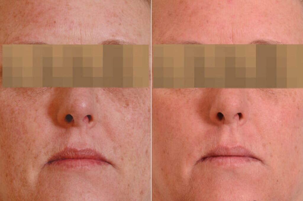 Chemical Peels Before After