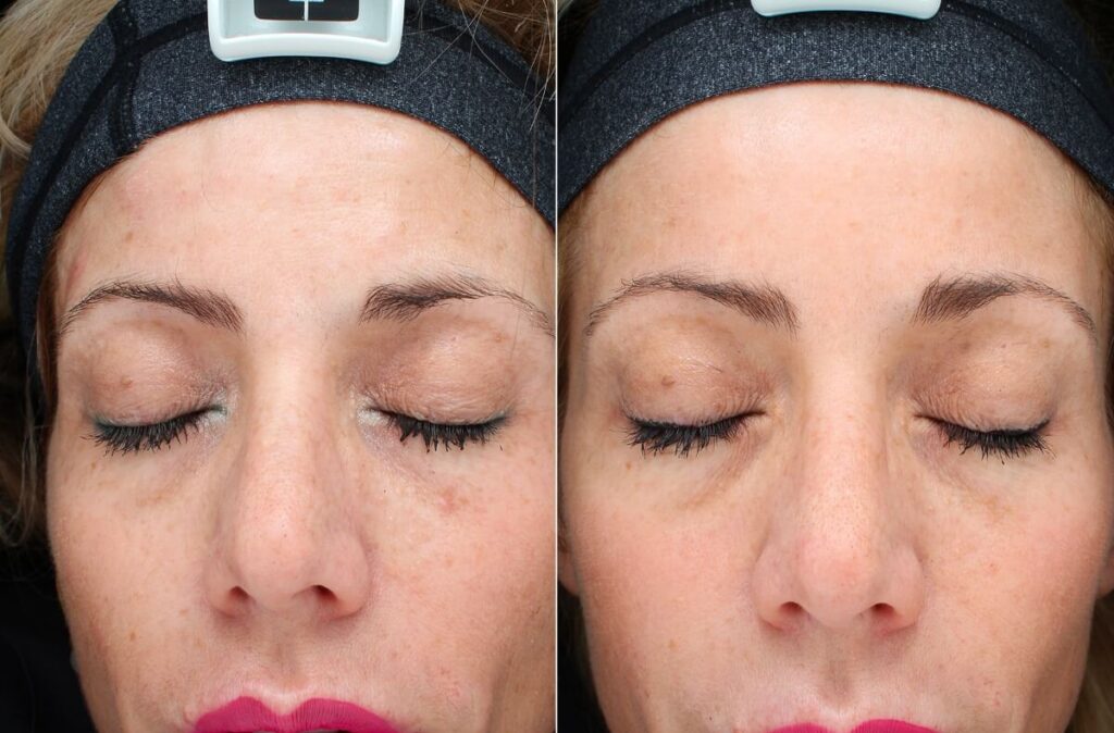 Chemical Peels Before After