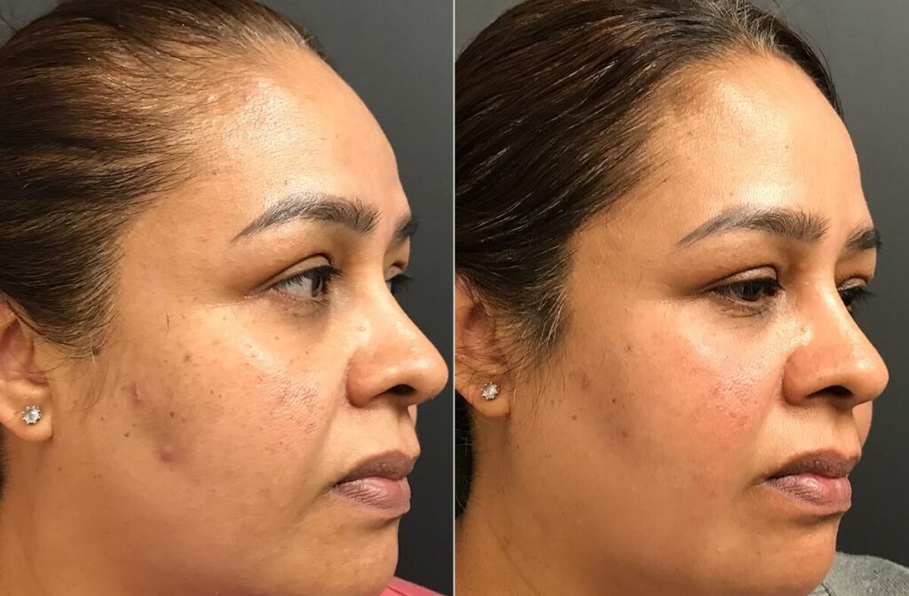 Chemical Peels Before After