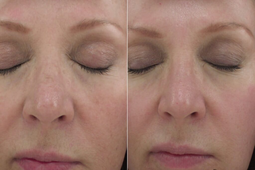 Chemical Peels Before After
