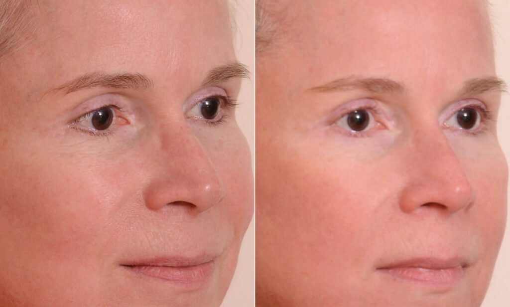 Chemical Peels Before After