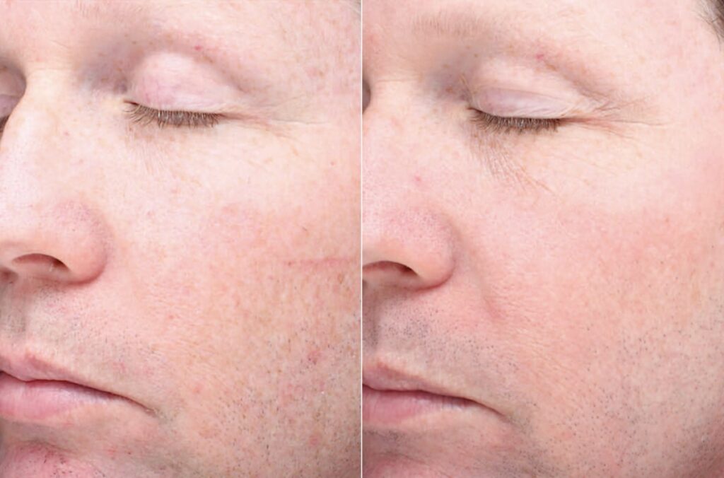 Chemical Peels Before After