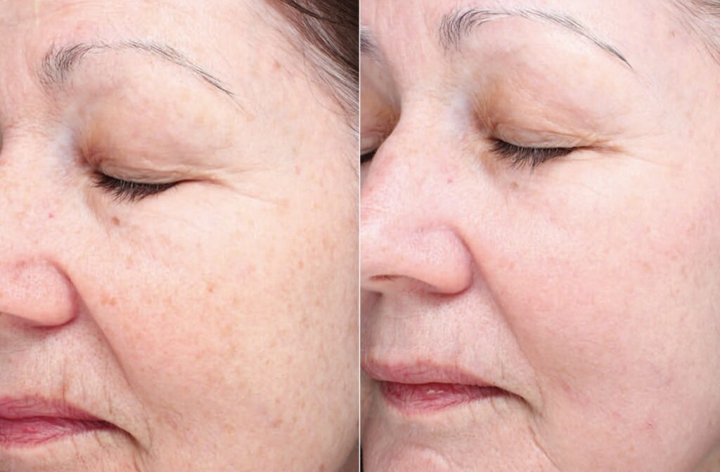 Chemical Peels Before After