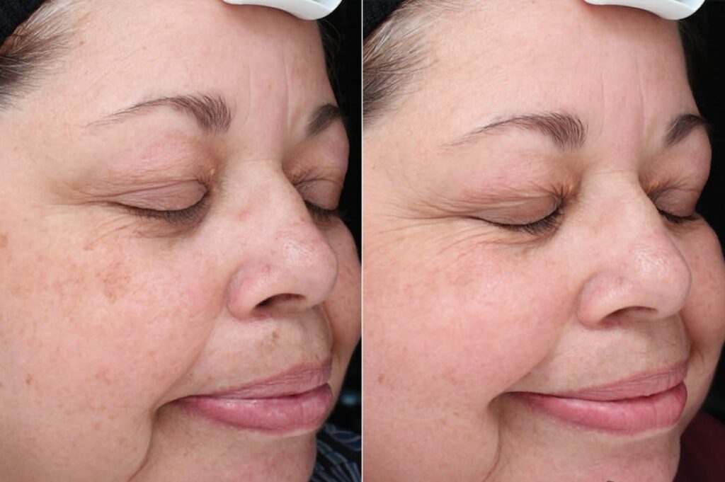 Chemical Peels Before After