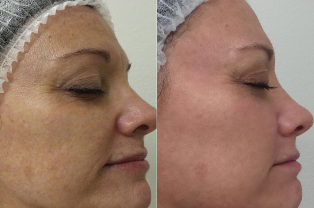Chemical Peels Before After