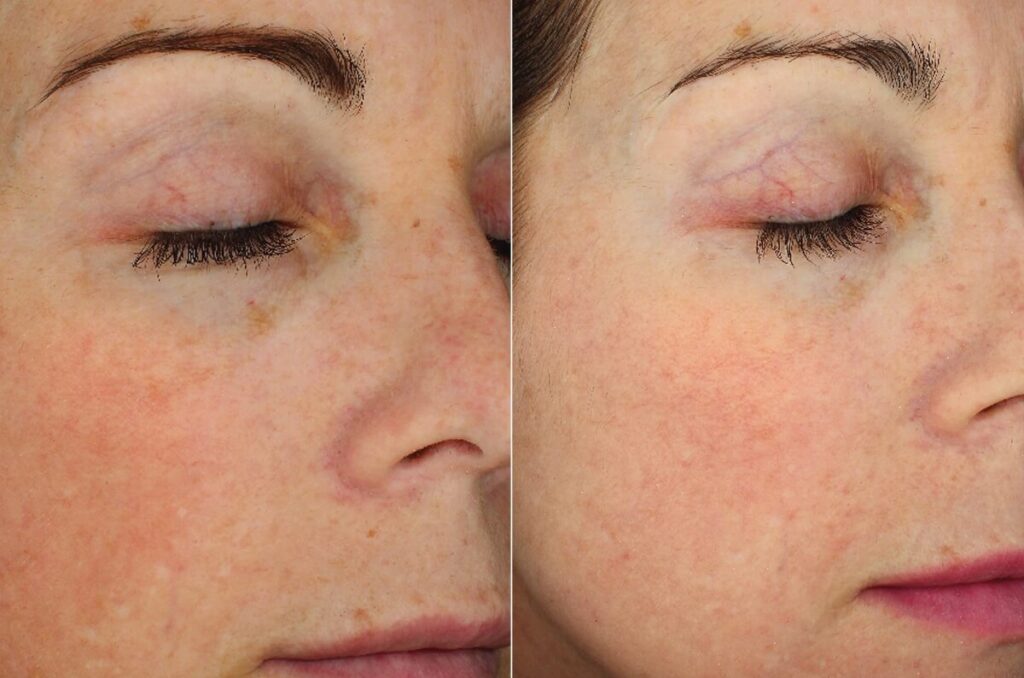 Chemical Peels Before After