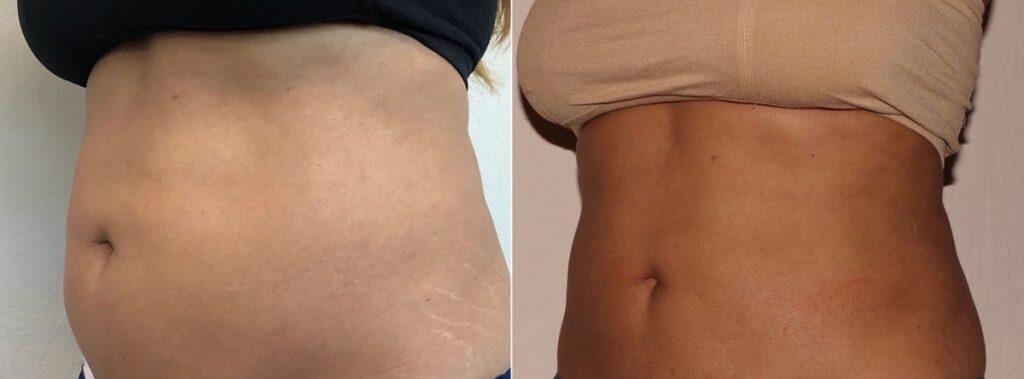 CoolSculpting Before After