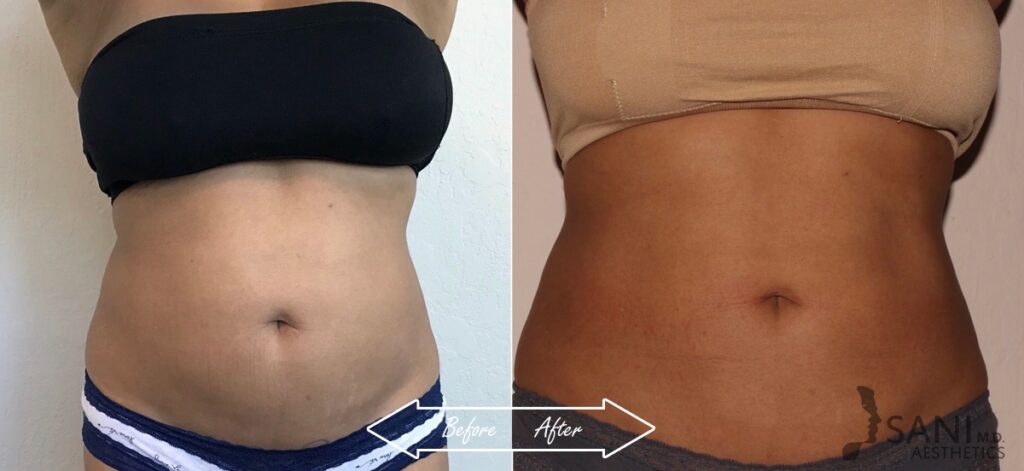 CoolSculpting Before After