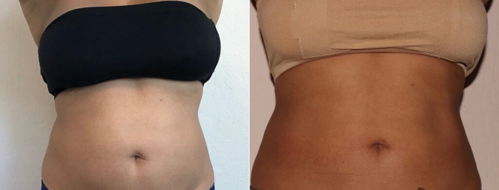 CoolSculpting Before After