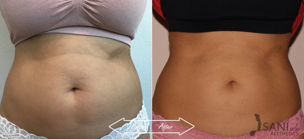CoolSculpting Before After