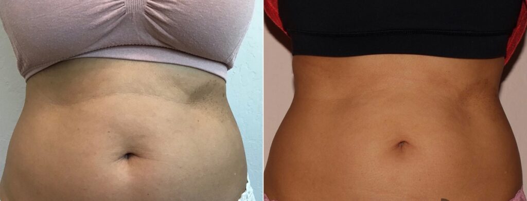 CoolSculpting Before After