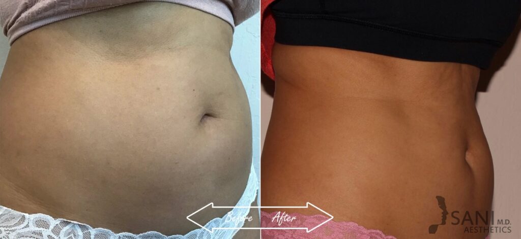 CoolSculpting Before After