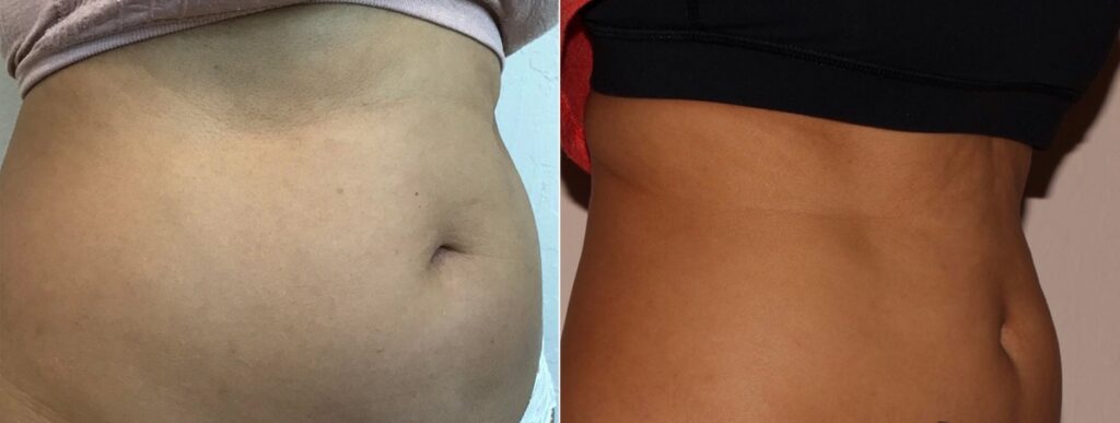 CoolSculpting Before After
