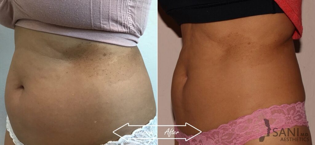 CoolSculpting Before After