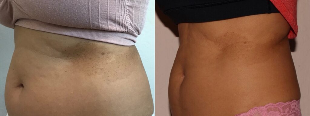 CoolSculpting Before After