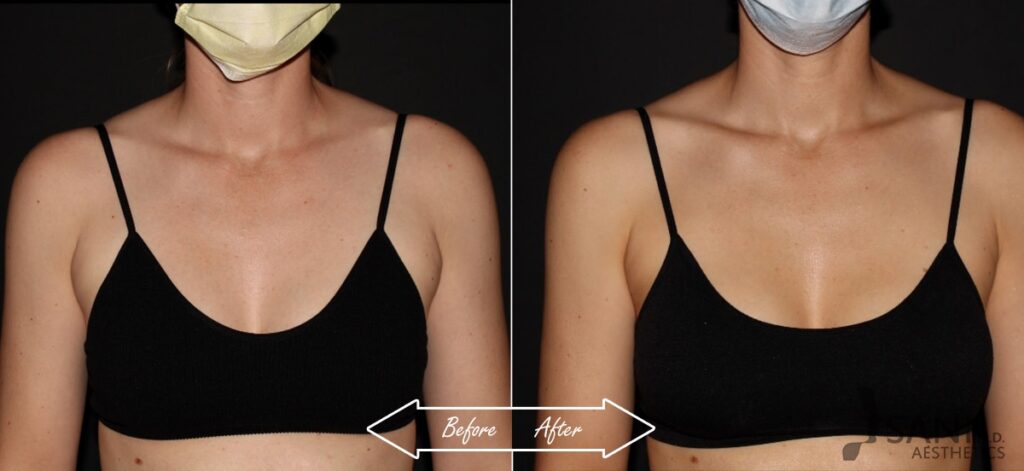 CoolSculpting Before After