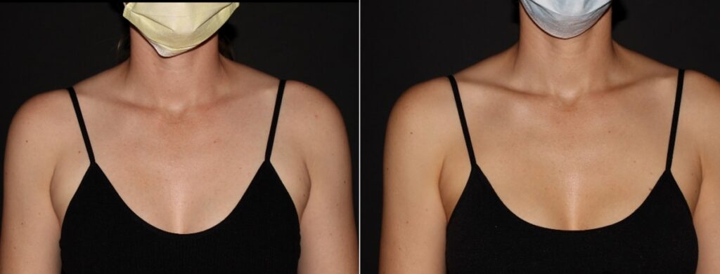 CoolSculpting Before After