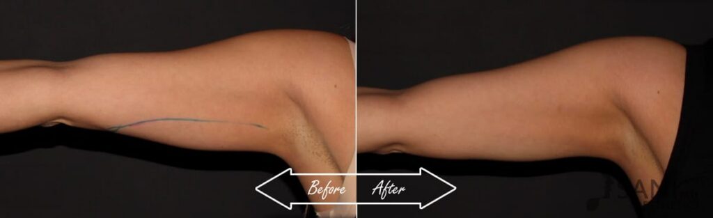 CoolSculpting Before After