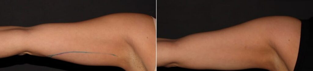 CoolSculpting Before After