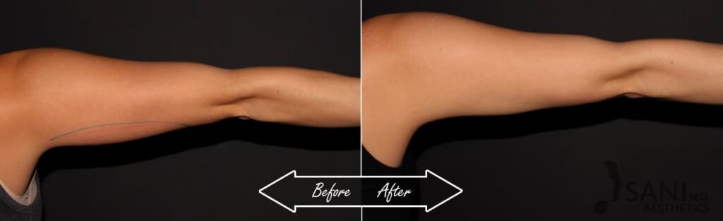 CoolSculpting Before After