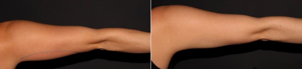 CoolSculpting Before After