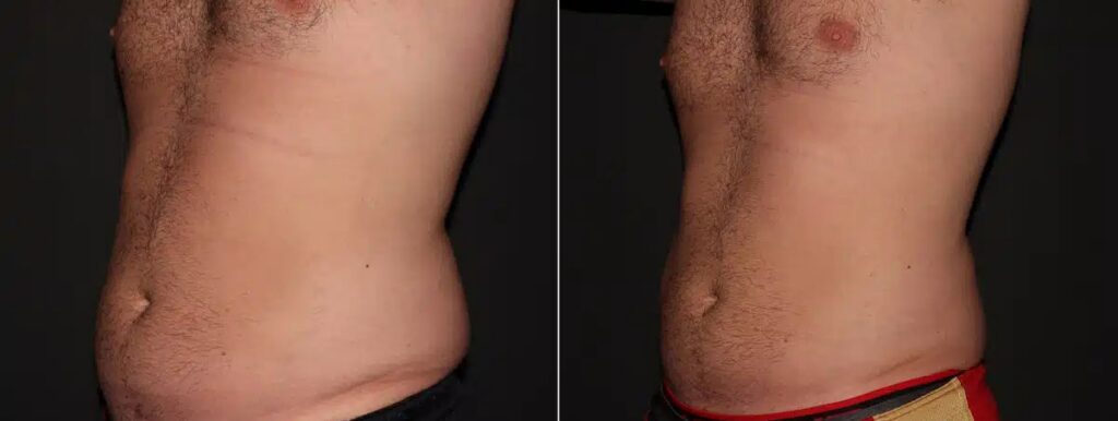 CoolSculpting Before After