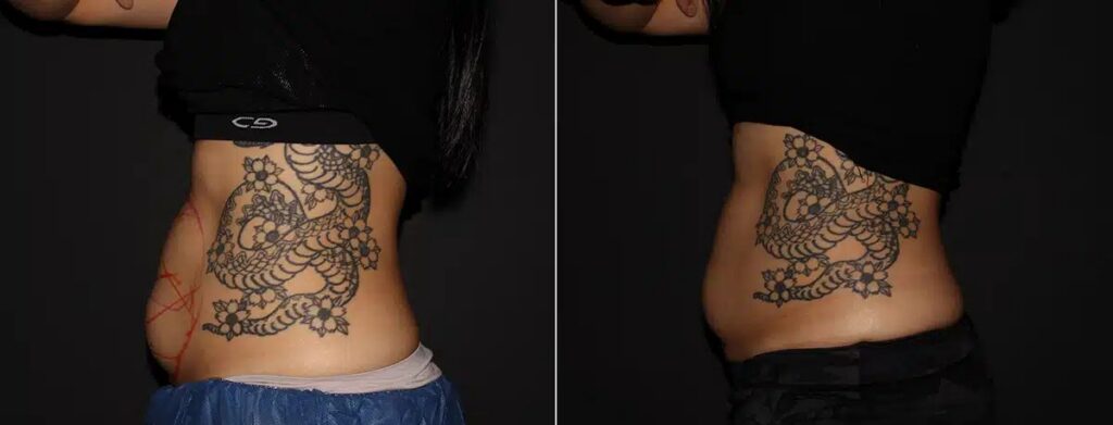 CoolSculpting Before After