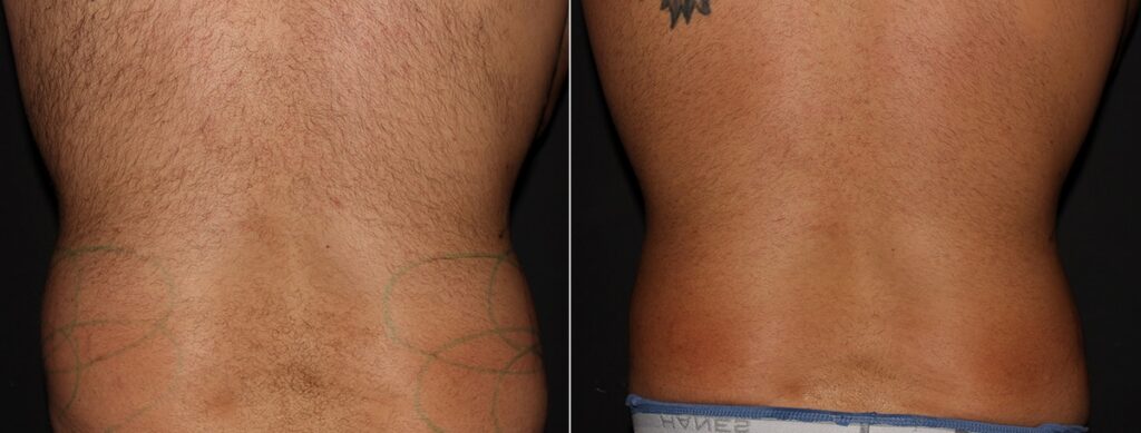 CoolSculpting Before After