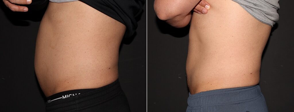 CoolSculpting Before After