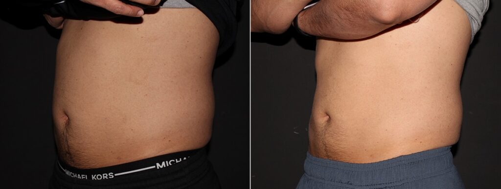 CoolSculpting Before After