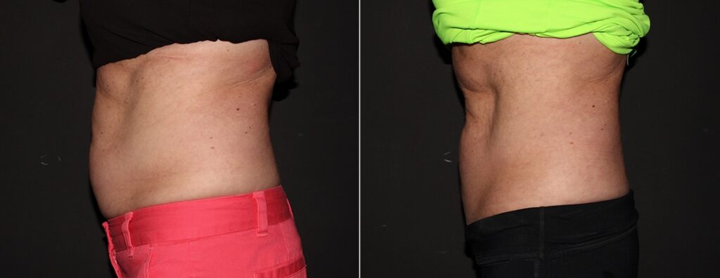 CoolSculpting Before After