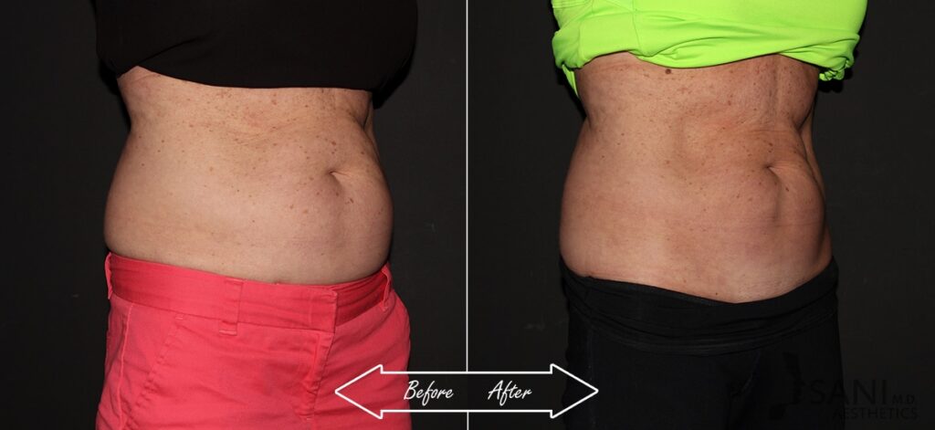 CoolSculpting Before After