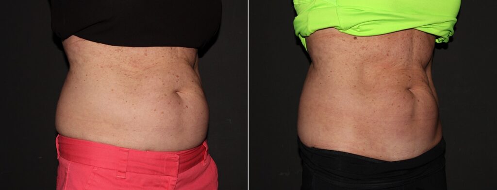 CoolSculpting Before After