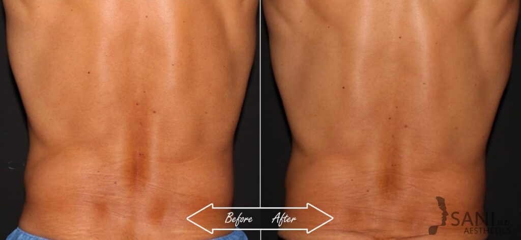 CoolSculpting Before After